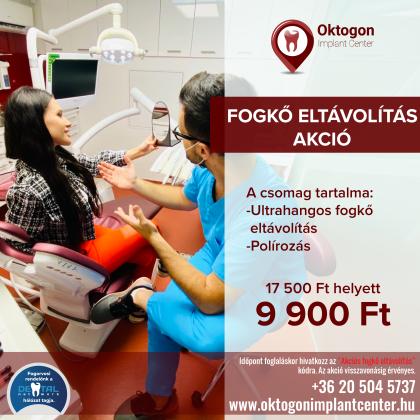 Fogkő Eltávolítás Akció Fogkő Eltávolítás Akció