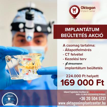 Implantátum beültetés akciós csomag Implantátum beültetés akciós csomag