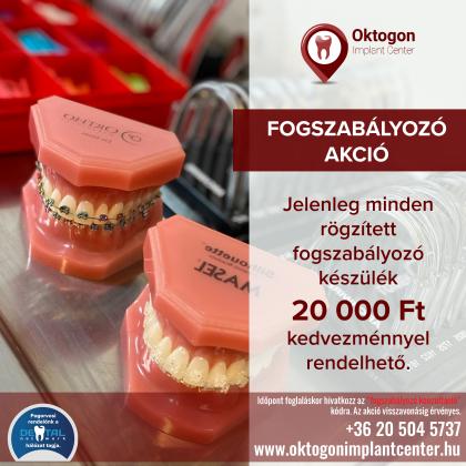Fogszabályozás AKCIÓ Fogszabályozás AKCIÓ