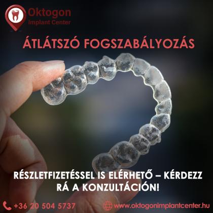 Átlátszó fogszabályozás részletfizetéssel Átlátszó fogszabályozás részletfizetéssel